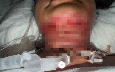 Gıdı estetiği sonrası nefes alamadı, boynundan acil solunum yolu açıldı
